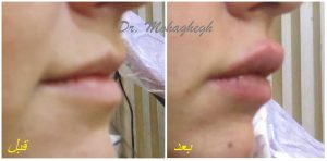 تزریق ژل لب غرب تهران