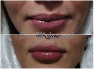 ژل و فیلر لب