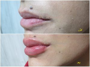 دکتر کاظم محقق تزریق ژل لب غرب تهران