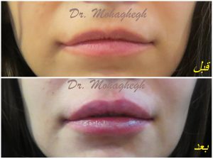 ژل لب عکس قبل و بعد تزریق توسط دکتر کاظم محقق بهترین مرکز تزریق ژل لب غرب تهران