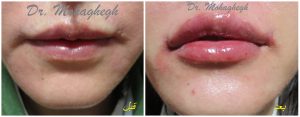 تزریق ژل لب عروسکی غرب تهران توسط بهترین مرکز تزریق زل و فیلر لب غرب تهران