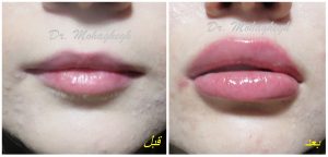 تزریق ژل لب غرب تهران