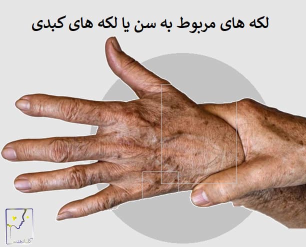 لکه های مربوط به سن یا لکه های کبدی