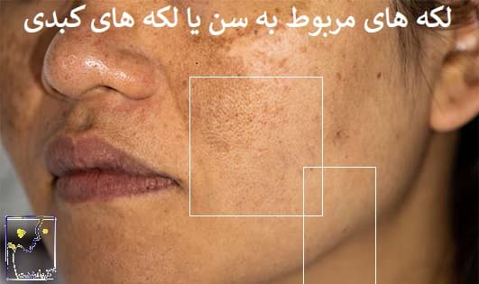 لکه های مربوط به سن یا لکه های کبدی