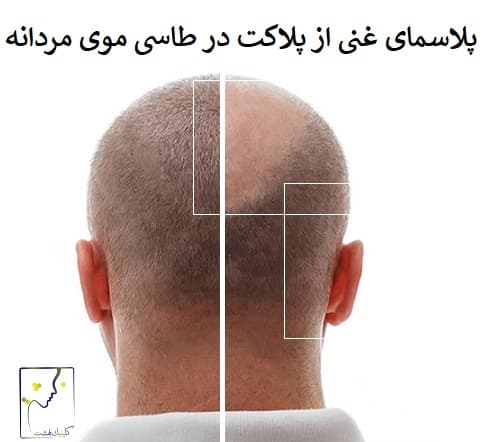 پلاسمای غنی از پلاکت در طاسی موی مردانه