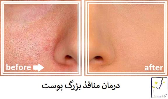 درمان منافذ بزرگ پوست