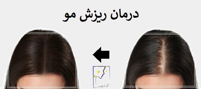 درمان ریزش مو