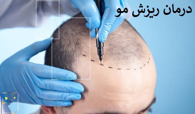 درمان ریزش مو