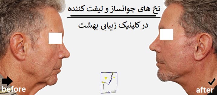 نخ های جوانساز و لیفت کننده در کلینیک زیبایی بهشت