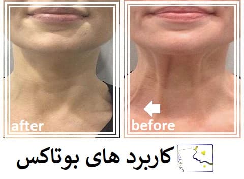 کاربرد های بوتاکس