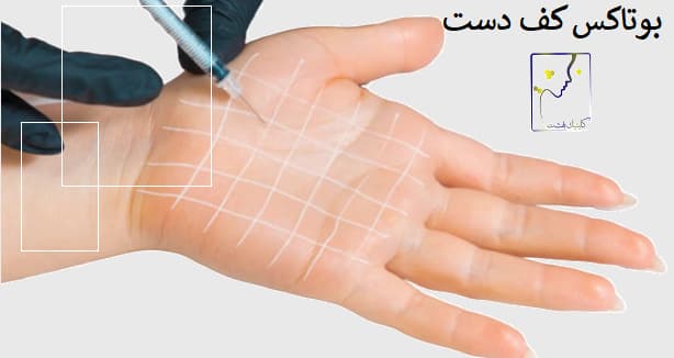 بوتاکس کف دست