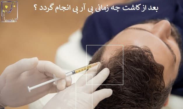 بعد از کاشت چه زمانی پی آر پی انجام گردد ؟