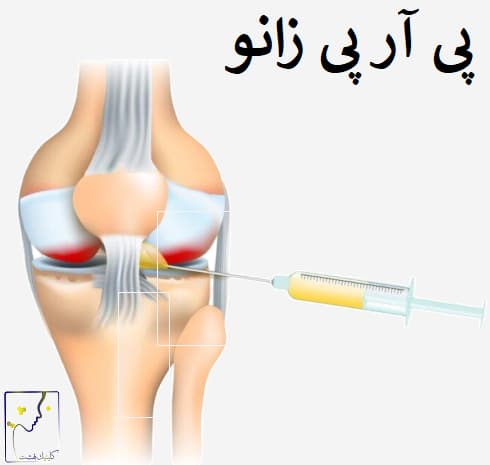 پی آر پی زانو