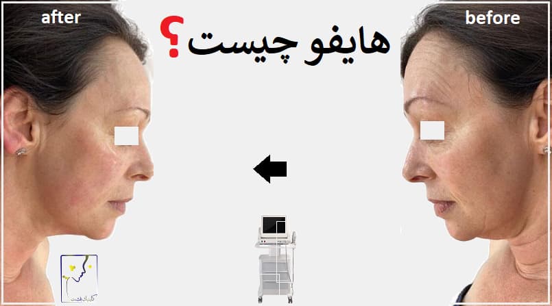 هایفو چیست؟