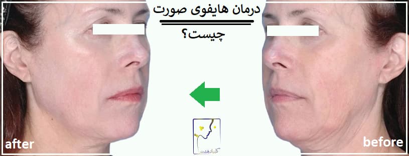 درمان هایفوی صورت چیست؟