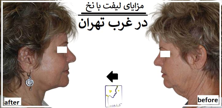 مزایای لیفت با نخ در غرب تهران
