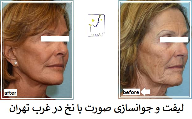 لیفت و جوانسازی صورت با نخ در غرب تهران