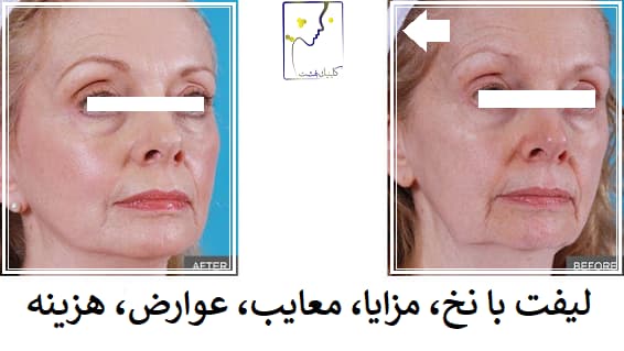 لیفت با نخ، مزایا، معایب، عوارض، هزینه