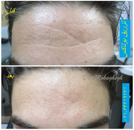 تزریق بوتاکس
