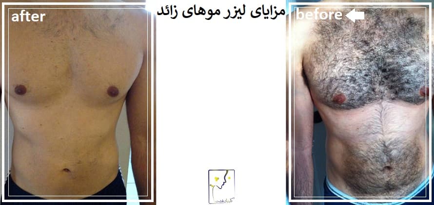 مزایای لیزر موهای زائد
