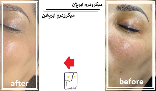 میکرودرم ابریژن, میکرودرم ابریشن