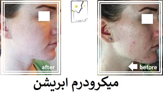 میکرودرم ابریشن