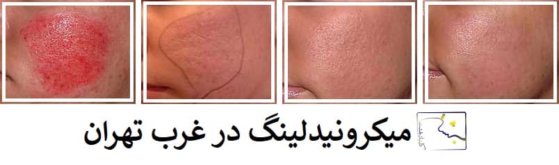 میکرونیدلینگ در غرب تهران