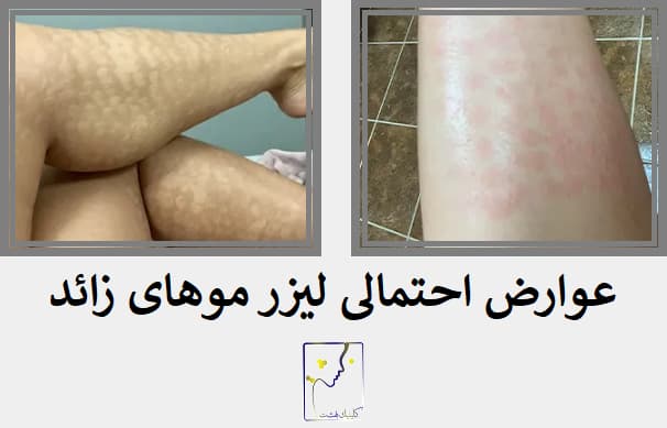 عوارض احتمالی لیزر موهای زائد
