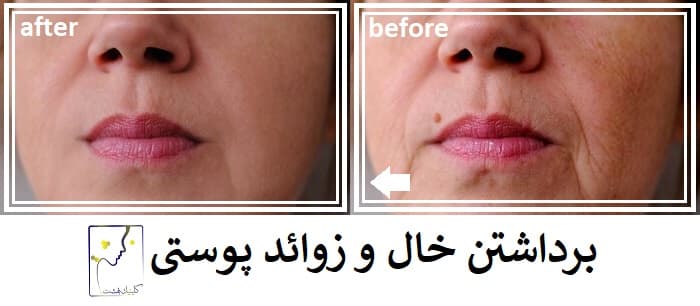 برداشتن خال و زوائد پوستی