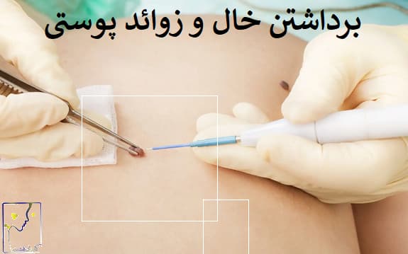 برداشتن خال و زوائد پوستی