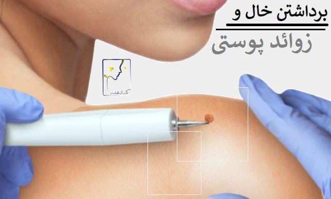 برداشتن خال و زوائد پوستی