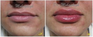 ژل لب روسی برای لب باریک