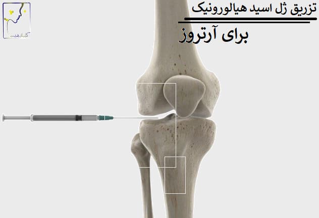 تزریق ژل اسید هیالورونیک برای آرتروز