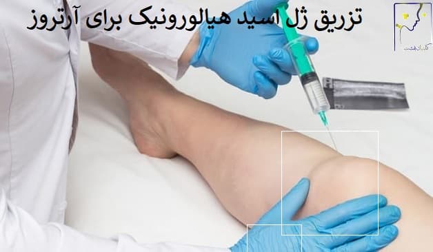 تزریق ژل اسید هیالورونیک برای آرتروز