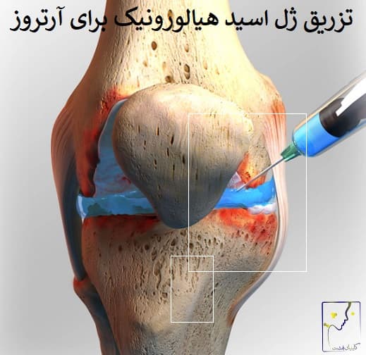 تزریق ژل اسید هیالورونیک برای آرتروز