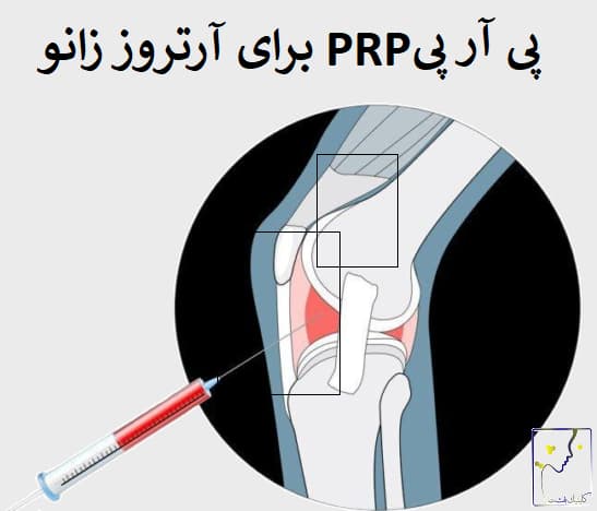 پی آر پی PRP برای آرتروز زانو