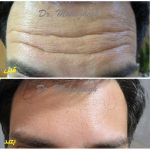تزریق بوتاکس