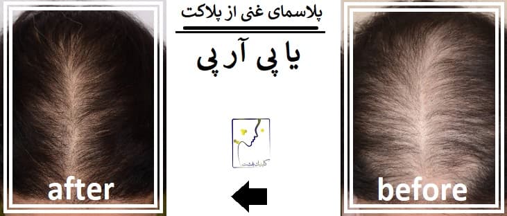 پلاسمای غنی از پلاکت یا پی آر پی