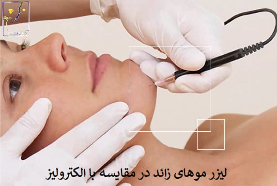 لیزر موهای زائد در مقایسه با الکترولیز