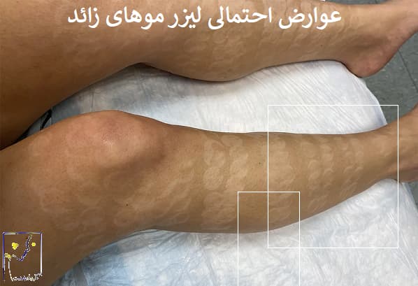 عوارض احتمالی لیزر موهای زائد