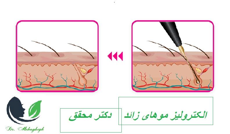الکترولیز مو