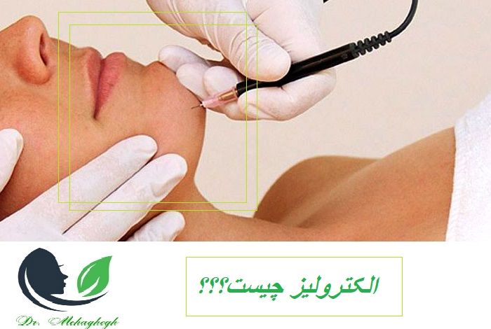 الکترولیز چیست