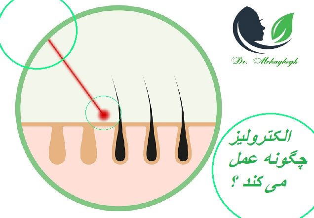 عملکرد الکترولیز