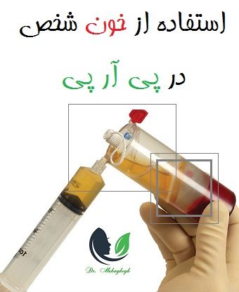 استفاده از خون شخص در پی آر پی