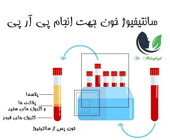 سانتیفیوژ خون جهت انجام پی آر پی