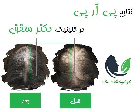 نتایج پی آر پی در کلینیک دکتر محقق