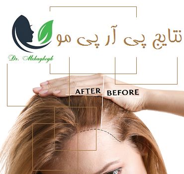 نتایج پی آر پی مو