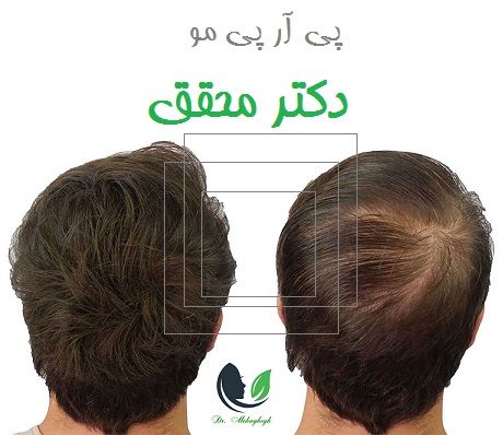 پی آر پی مو دکتر محقق