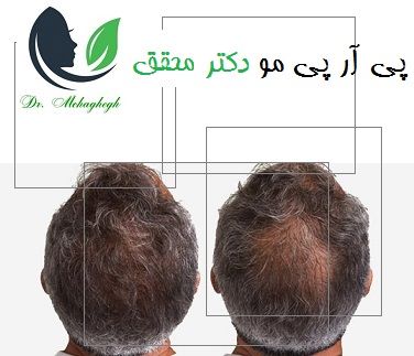 پی آر پی مو دکتر محقق