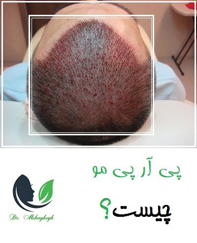 پی آر پی مو چیست؟